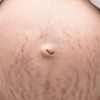 産後ママお腹のたるみ＋妊娠線ケア