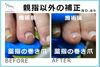 薬指の矯正写真２「薬指も巻き爪の矯正が出来ますか？」