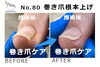 N80.巻き爪根本上げの施術事例２「N80.巻き爪根本上げの施術事例」