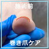 巻き爪ケア事例No.94-3「爪が上にもちあげられてる感じ　巻き爪ケア事例No.94」