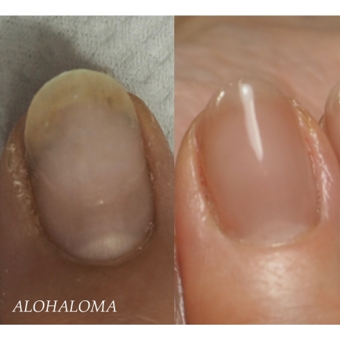 トラブル爪の育成 Nail Salon Alohaloma アロハロマ のニュース まいぷれ 福井 トラブル爪の育成 Nail Salon Alohaloma アロハロマ のニュース まいぷれ 福井