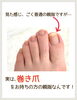 かくれ巻き爪さん⁈「【巻き爪】気づいてないだけかも⁈」