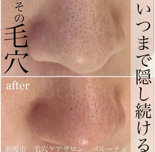 毛穴エクストラクションプロ認定サロン Total Beautysalon Beluce トータルビューティーサロン べルーチェ のニュース まいぷれ 朝霞 志木 新座 和光 毛穴エクストラクションプロ認定サロン Total Beautysalon Beluce トータルビューティーサロン べルーチェ のニュース まいぷれ 朝霞 志木 新座 和光