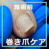 No.75巻き爪施術前「No.75 矯正中もキレイな爪」
