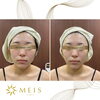 BeforeAfter「リフトアップ、小顔効果抜群 Before After」