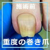 No.72ストロー重度の巻き爪施術事例３「No.72ストロー重度の巻き爪」