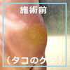 No.62たこ施術事例３「No.62たこのケア施術事例」
