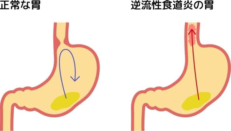 背骨矯正と内臓マニピュレーションが効果的「逆流性食道炎、胸やけの改善に☆初回4800円☆」