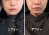 お顔の余白が減りキュッと小顔になりました(1回目)「能見台駅から徒歩2分Pearlbliss(ﾊﾟｰﾙﾌﾞﾘｽ)」