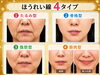 「📺NIB「ひるじげドン」10月放送後記👑佐世保市・四ヶ町アーケードでサザクリの星の王子（星野院長）が「ほうれい線」について解説✨」