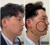 男性にも大人気！「ハイフモニター大募集！！【福井エステ/ハイフ/フェイシャル/小顔】」