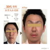 「最短1ヶ月の集中美肌ケア✨ビフォーアフター公開❗️【宮崎市 LIHI 肌育 毛穴ケア 角質ケア】」