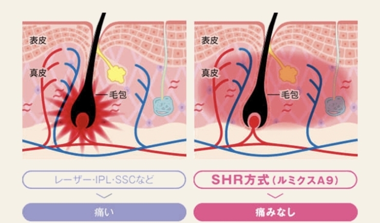 「最強美容脱毛器キャンペーンその1♪」