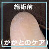No.53かかとケアの施術事例３「No.53かかとケアの施術事例」