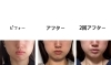 輪郭、あご、リフトアップの変化がよくわかりますね「能見台駅から徒歩2分Pearlbliss(ﾊﾟｰﾙﾌﾞﾘｽ)」