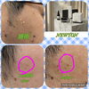 before・after「７月よりスポットシミケア【NEWTON】はじめます！　整体室BODYCAREろはす　江南市　大口町　扶桑町　犬山市　岩倉市」