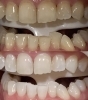 before after「【症例写真】歯が白くなると、表情まで明るく変わります！」