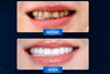 「Nha khoa Phú Nhuận : Bảng giá bọc răng sứ thẩm mỹ tại Smilux Dental」