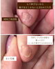 4ヶ月で爪の悩みが綺麗に解消「伸びないと言われた爪【福井/フットケア/足の爪】」