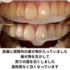 before after「差し歯があっても理想の白さへ！メディカルホワイトニングで自信の笑顔に」