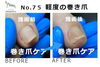 No.75巻き爪施術前後比較２「No.75 矯正中もキレイな爪」