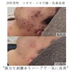 「ハーブ劇的ビフォーアフター(ニキビ・ニキビ跡編)【 福井フェイシャルエステ/ 福井美肌/ 福井ハーブピーリング 】」