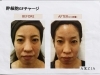 お顔がしまって小顔に！肌質が滑らかに改善「ハリと弾力ってこういうこと？！話題の幹細胞を基底膜にダイレクト注入♡お試しキャンペーン実施中！」