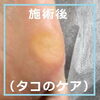 No.62たこ施術事例４「No.62たこのケア施術事例」