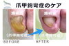 No.56病院で断られた爪甲鉤彎症のケア２「No.56病院で断られた爪甲鉤彎症のケア」