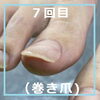 No.52巻き爪ケア「矯正中でも出せる爪」４「No.52巻き爪ケア「矯正中でも出せる爪」」