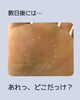 小さなウオノメでも…「【ウオノメケア】足裏にトゲが刺さった⁈」
