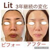幹細胞導入で叶えた美肌へ「Litで続けた2〜3年の変化をご紹介します」
