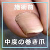 No.77　中度の巻き爪のケア１回目３「No.77　中度の巻き爪のケア１回目」