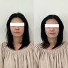 「小顔メニューとセットで美白肌も手に入る！【 福井フェイシャルエステ/福井美白/福井復元フェイシャル/福井美肌/目の下のクマ取り/福井小顔/たるみ改善 】」