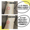 「【Qスイッチレーザー 柳沢Dr.の経過❤️‍🩹】」