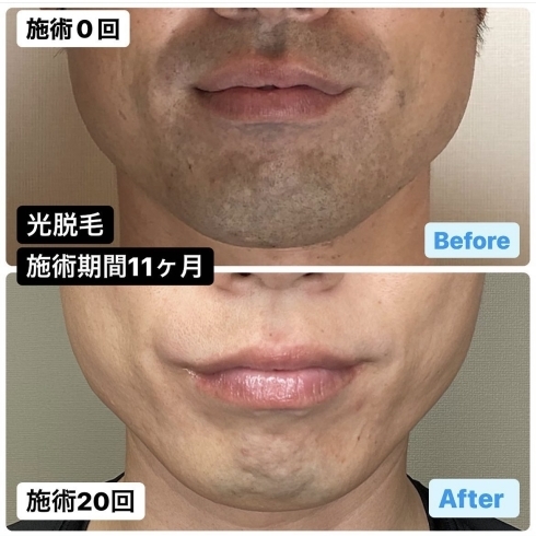 いつまで毛は濃くなるの Tails テイルス メンズ脱毛サロンのニュース まいぷれ 三島 いつまで毛は濃くなるの Tails テイルス メンズ脱毛サロンのニュース まいぷれ 三島