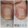 巻き爪改善 足のトラブルもお任せください 福井市 ネイルサロン 巻き爪補正 Nail Salon Alohaloma アロハロマ のニュース まいぷれ 福井 巻き爪改善 足のトラブルもお任せください 福井市 ネイルサロン 巻き爪補正 Nail Salon Alohaloma アロハロマ のニュース まいぷれ 福井