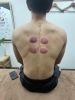 コンディショニングではインディバやカッピングを使用「日本体育大学ゴルフ部部長。 学生ゴルフ選手の「トレーニング」と「コンディショニング」の流れ。」