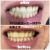  before after 一例