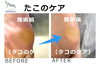 No.62たこ施術事例２「No.62たこのケア施術事例」