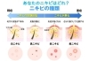 あなたは どの種類ですか？「あなたのニキビは どの種類ですか？」