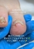 「歩くたびにズキッ…巻き爪のお悩みは早めのケアを」
