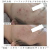 「ハーブ劇的ビフォーアフター(ニキビ・ニキビ跡編)【 福井フェイシャルエステ/ 福井美肌/ 福井ハーブピーリング 】」