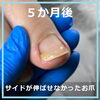 No.104ー５「長年痛みをこらえて切っていたお爪　No.104」