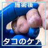 たこのケア事例No.85-4「もう指はいらないとさえ思った。たこのケア事例No.85」