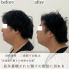 「劇的ビフォーアフター（顎下編）【福井小顔/福井フェイシャルエステ/福井ハーブピーリング/福井ハイフ】」