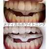 メディカルホワイトニング「夏の笑顔をもっと輝かせる！理想の白い歯で自信アップ」